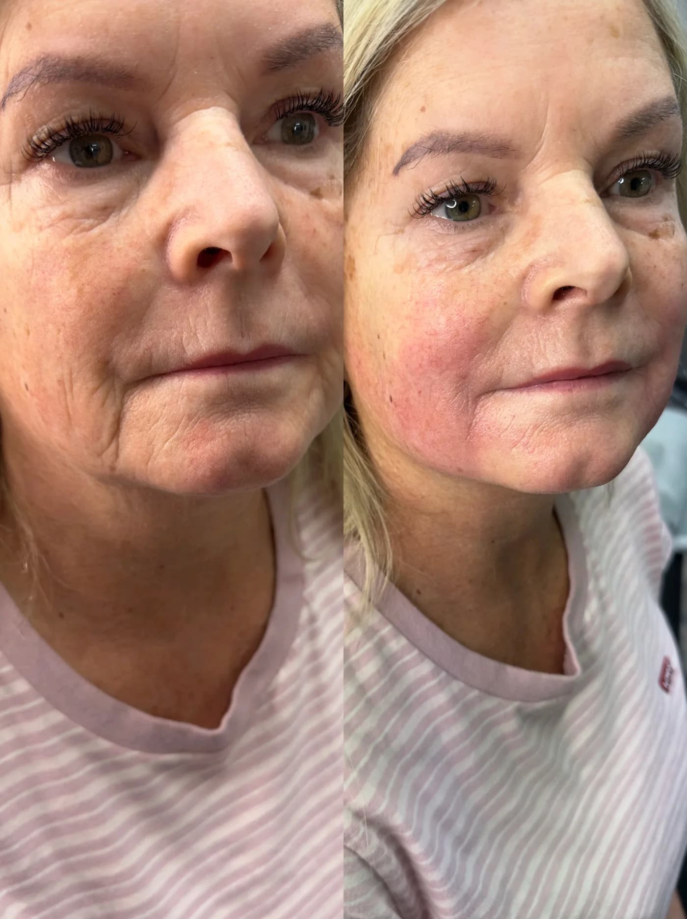 Side by side before and after photograph of a HIFU skin treatment carried out at Suburban Glow's Handforth studio